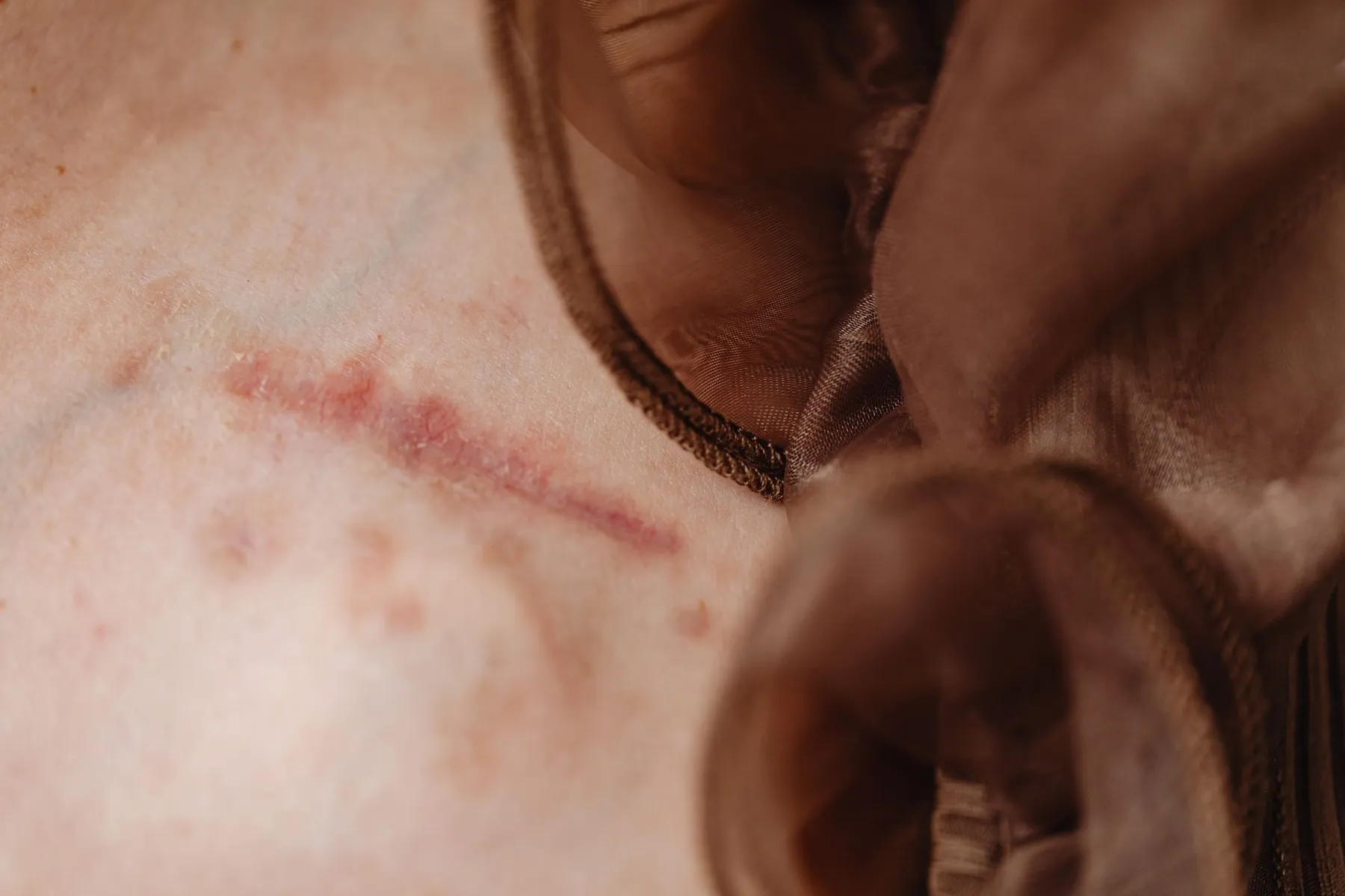 Skin texture close up, illustrating how scars change over a year.
