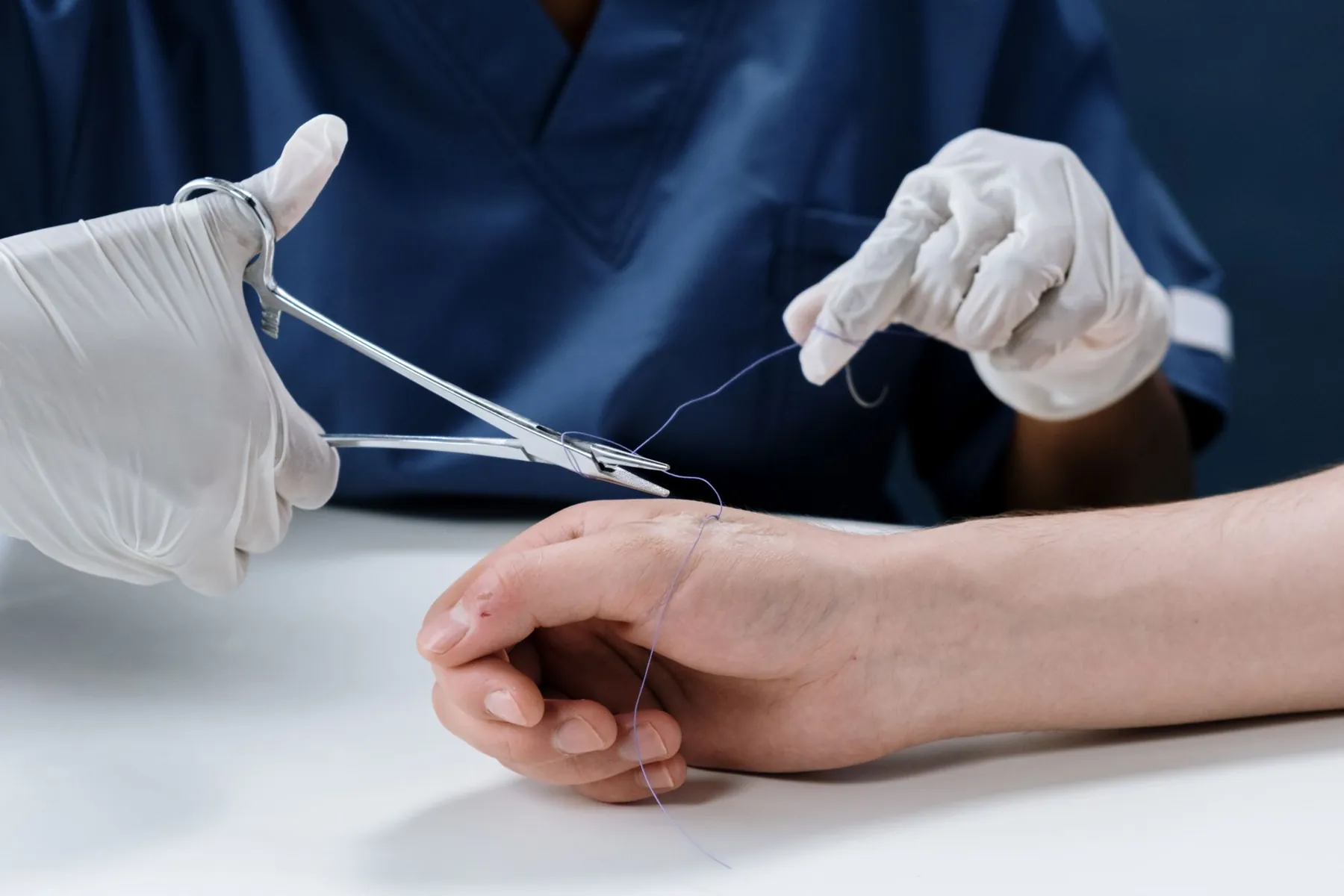 Fine suture thread, illustrating the stitches removed at around a week.